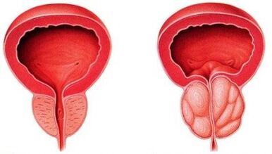 próstata saudável e inflamada com prostatite