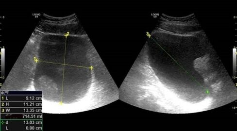 sinais de prostatite na ultrassonografia
