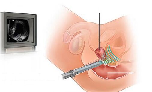 ultrassom da próstata